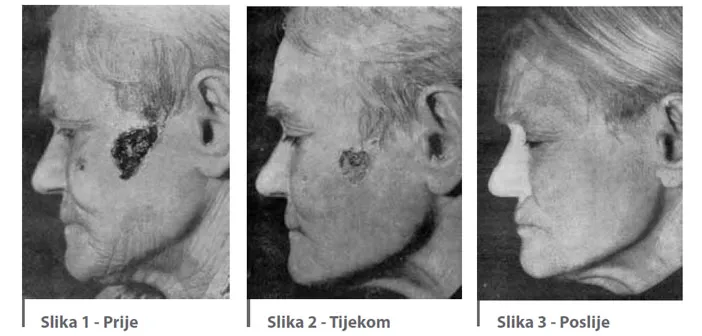 Tri fotografije istog pacijenta: pre, tokom i posle terapije oscilatorom, 1940-ih